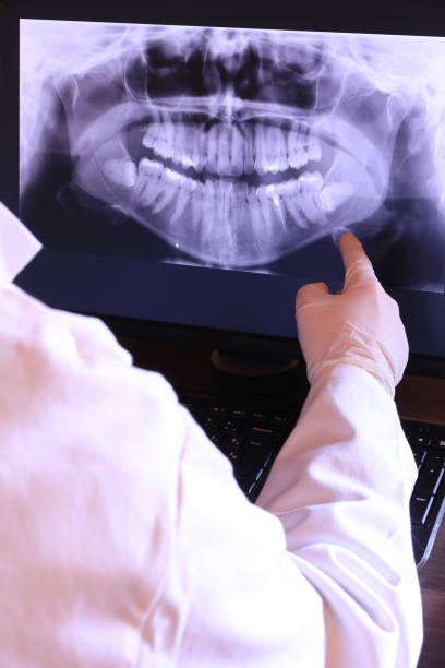 Best Emergency Wisdom Teeth Removal in Santa Clara, CA
